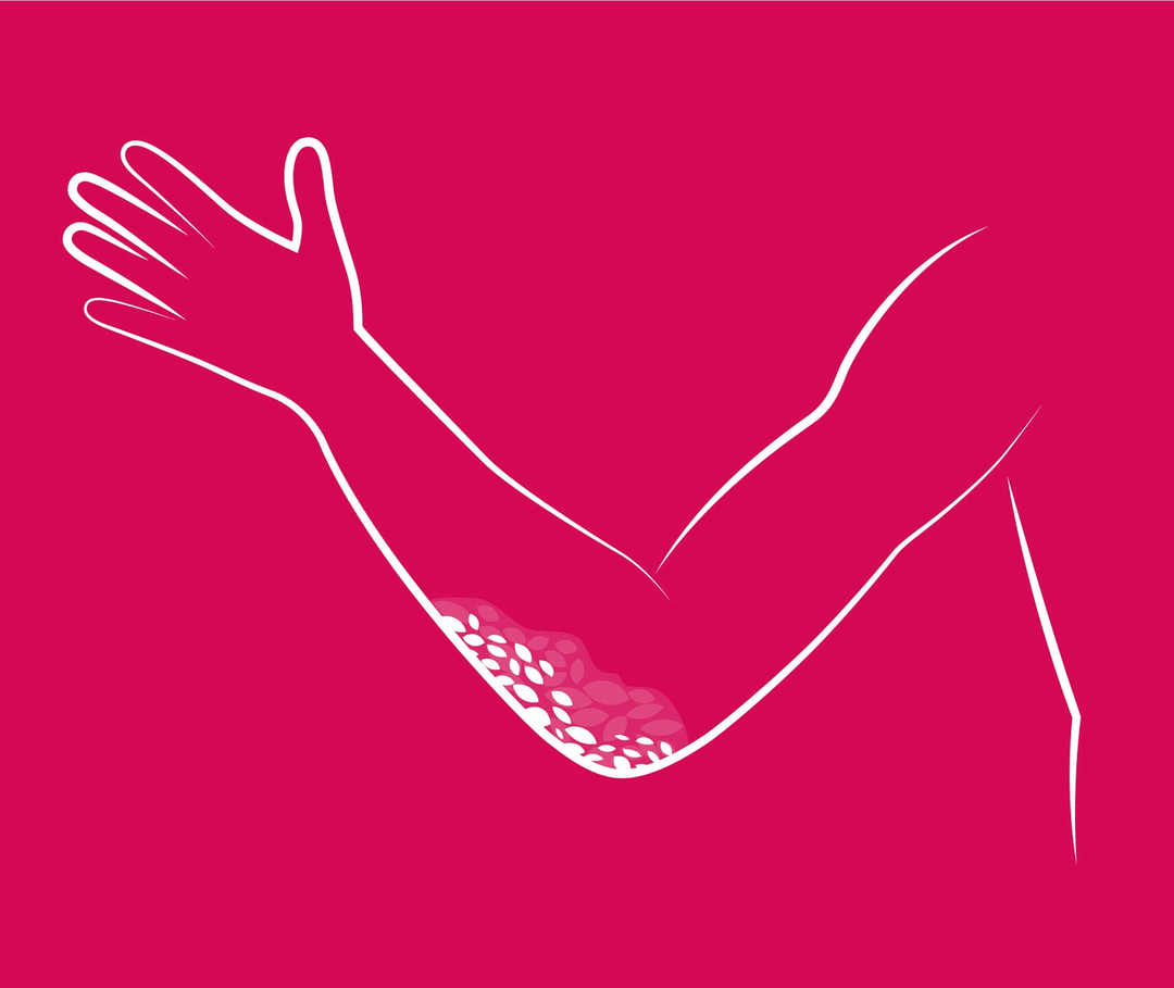 Teaser Psoriasis